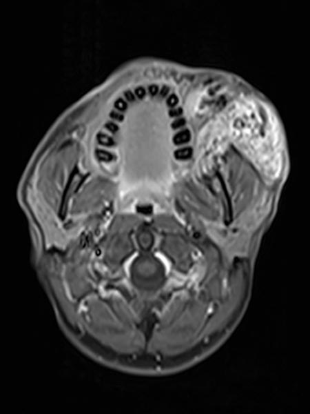 MRI: arteriovenous malformation