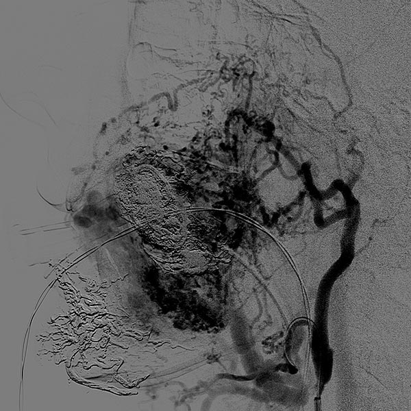 DSA: after contrast injection into the left external carotid artery