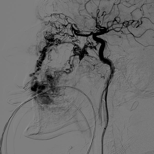 DSA: after contrast injection in the left internal carotid artery