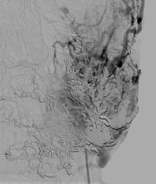 DSA: direct percutaneous puncture of the nidus