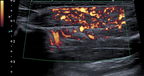 Power Doppler imaging – Subcutaneous infantile hemangioma