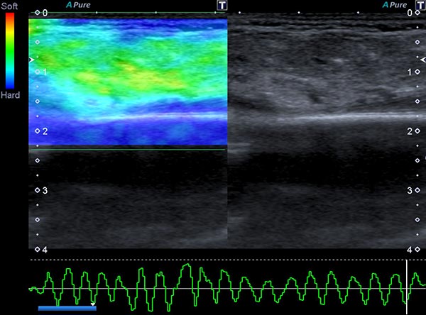 Ultrasound elastography – Subcutaneous infantile hemangioma
