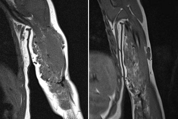 MRI – Infantile hemangioma