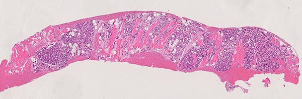Histopathological image H&E stain – Subcutaneous infantile hemangioma