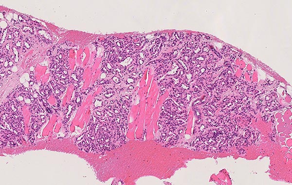 Histopathology H&E stain – Subcutaneous infantile hemangioma