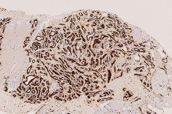 Histopathology CD31 staining – Subcutaneous infantile hemangioma