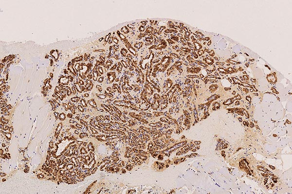 Histopathology SMA – Subcutaneous infantile hemangioma