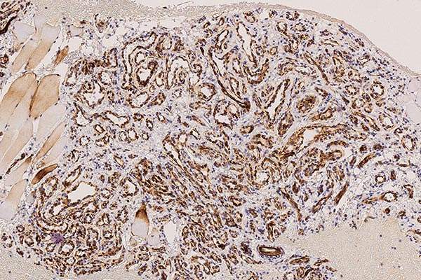 Histopathology WT1 staining – Subcutaneous infantile hemangioma