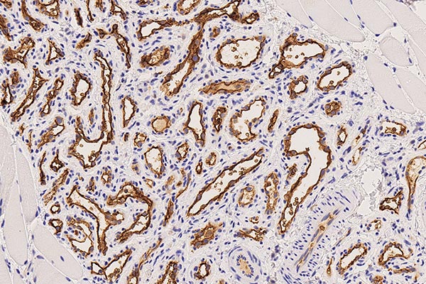 Histopathology GLUT1 staining – Subcutaneous infantile hemangioma