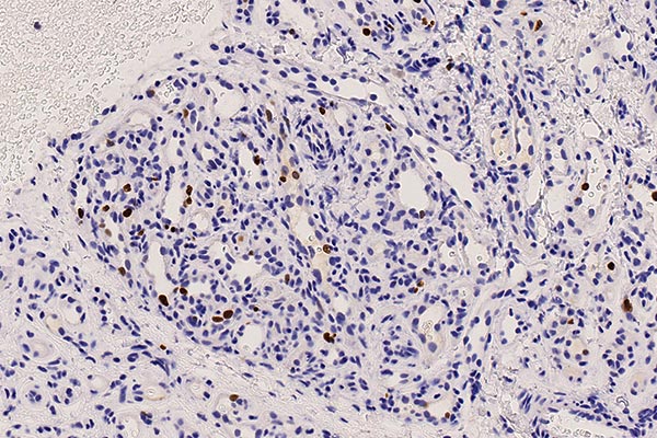 Histopathology Ki67 – Subcutaneous infantile hemangioma