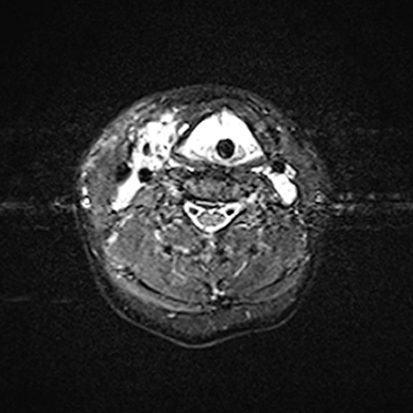MRI – Upper airway obstruction