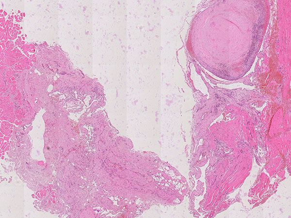 Histopathology H&E staining – Upper airway obstruction