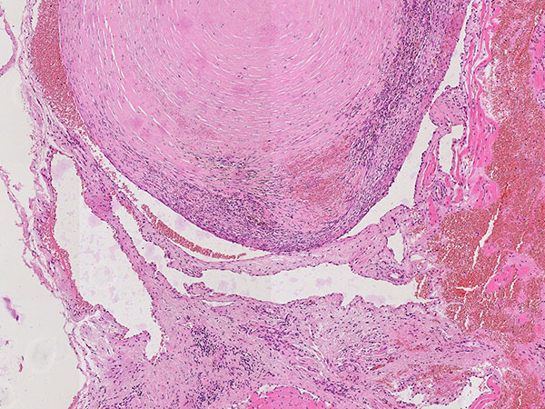 Histopathology H&E staining – Upper airway obstruction