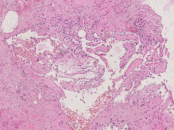 Histopathology H&E staining – Upper airway obstruction