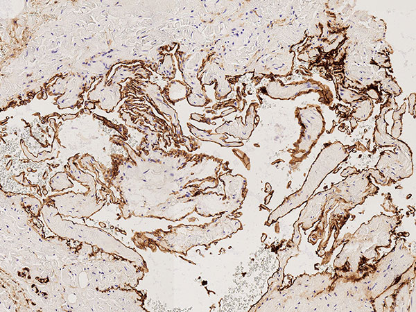 Histopathology CD-31 staining – Upper airway obstruction