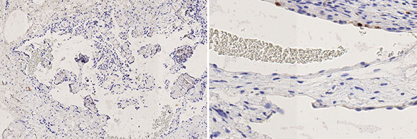 Histopathology Ki67 stain – Upper airway obstruction