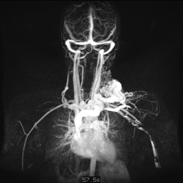 MR angiography – Arteriovenous malformation of neck/chest