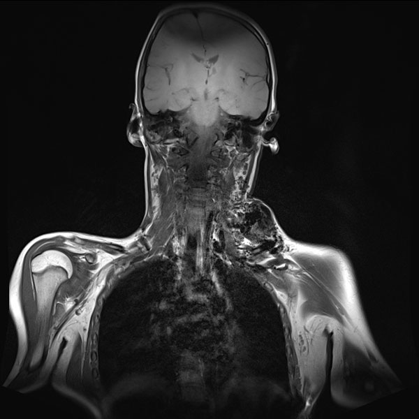 MRI – Arteriovenous malformation of neck/chest