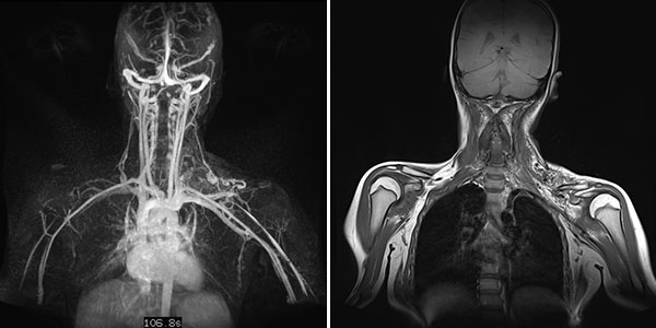 MR angiography  – Arteriovenous malformation of neck/chest