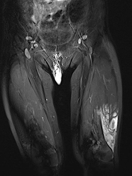 MRI – Venous malformation on the labium majus