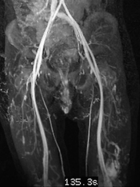 MRI – Venous malformation on the labium majus