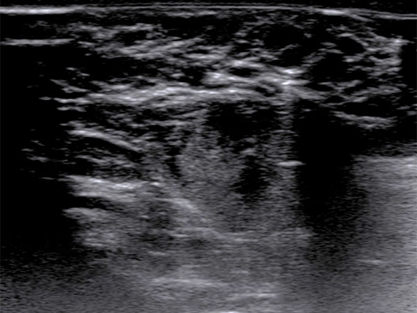 Sonography – Venous malformation on the labium majus