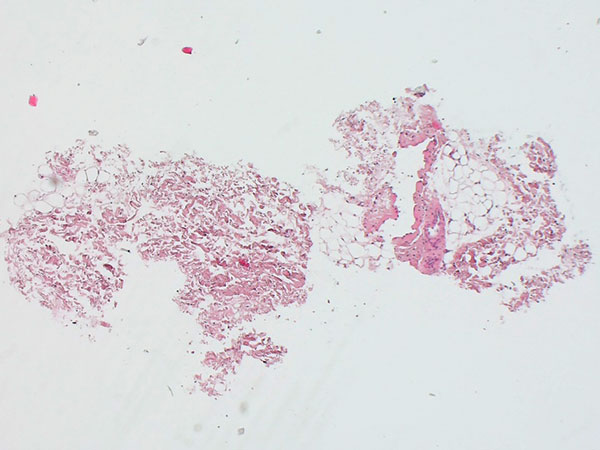 Histopathology H&E stain – Venous malformation on the labium majus