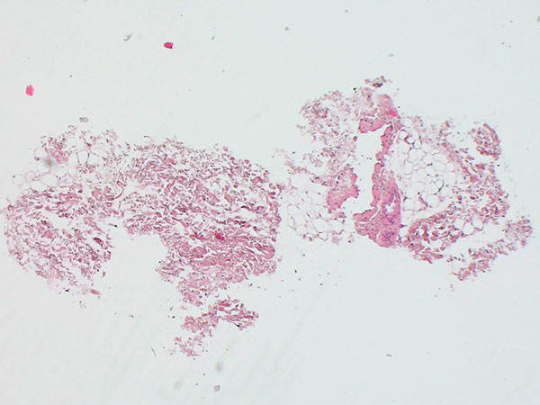 Histopathology H&E stain – Venous malformation on the labium majus