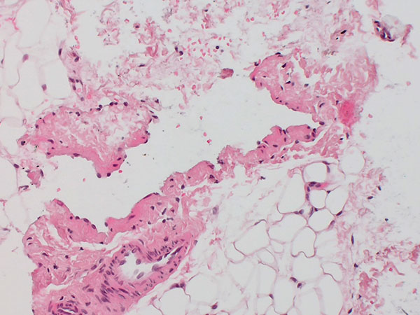 Histopathology (HE) – Venous malformation on the labium majus