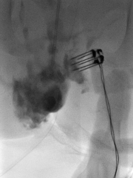Bleomycin elekctro sclerotherapy – Venous malformation on the labium majus