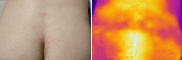 Infrared thermography  – Intramuscular venous malformation