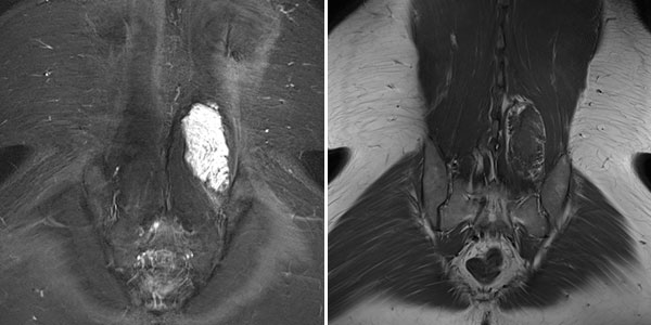 MRI  – Intramuscular venous malformation