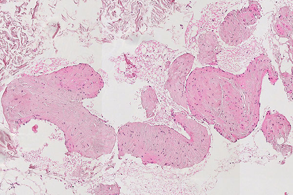 Histopathology H&E stain – Intramuscular venous malformation