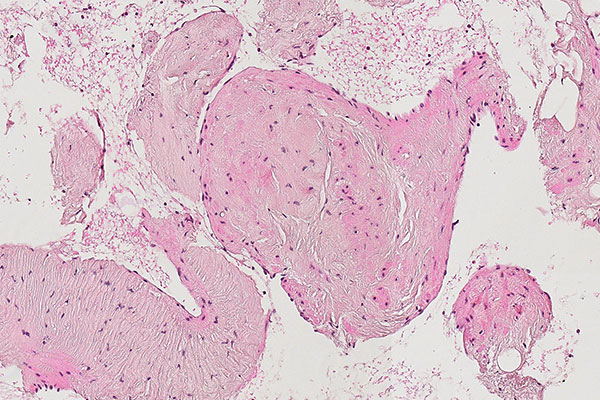 Histopathology H&E stain – Intramuscular venous malformation