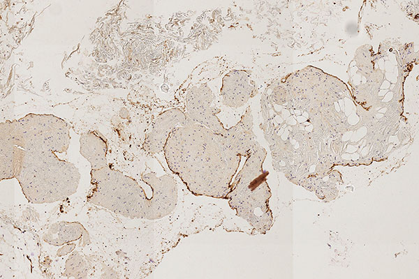 Histopathology CD31 stain – Intramuscular venous malformation