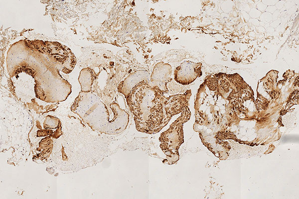 Histopathology SMA stain – Intramuscular venous malformation