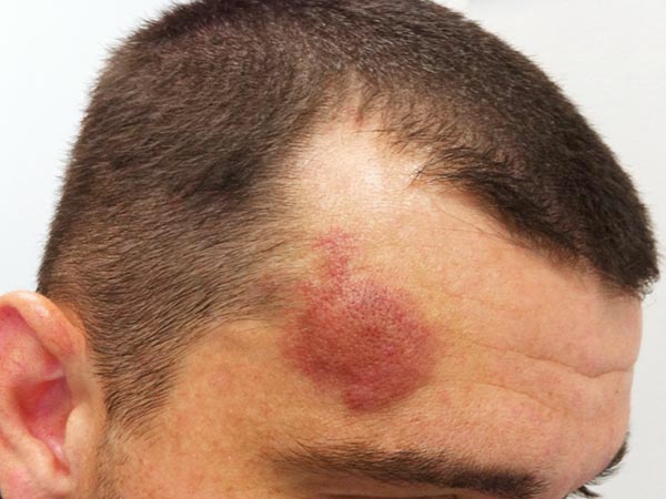 Arteriovenous malformation on the forehead