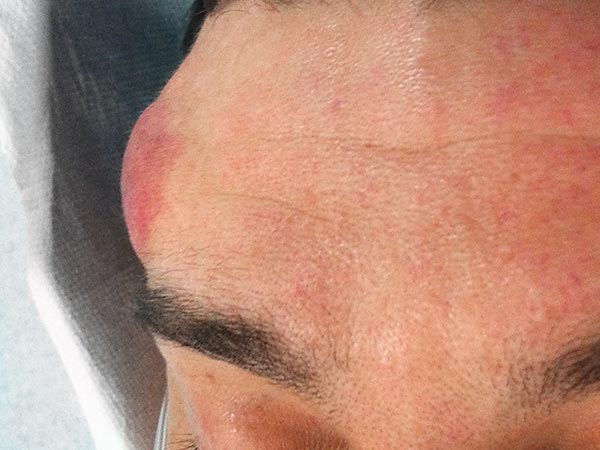 Arteriovenous malformation on the forehead