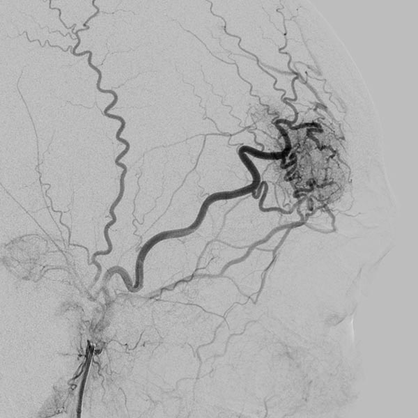 DSA: with contrast injection into the right external carotid artery