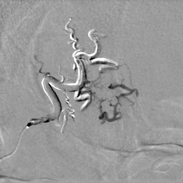 DSA: embolic agent is pressed into the lesion