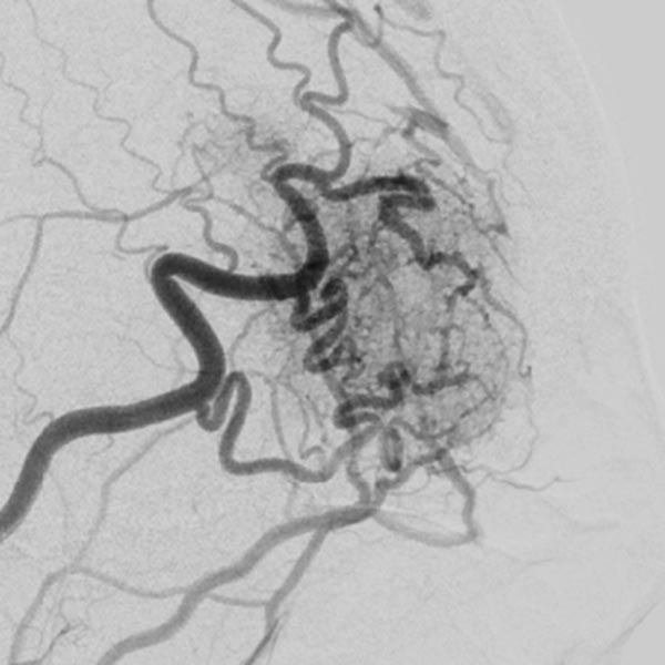DSA: depicting the arterial inflow, nidus with small arteriovenous fistulae