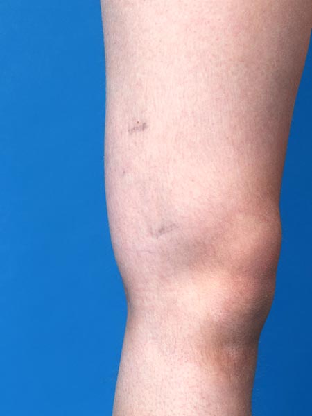 Swelling on the lateral distal thigh