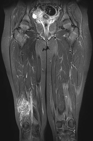 MRI: venous malformation on the thigh