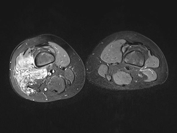 MRI: close relationship to the periosteum of the femur