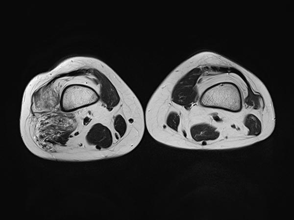 MRI: multiple inflammations