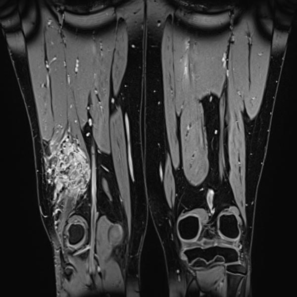 MRI, T1-weighted, fat-saturated