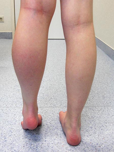 Swelling and volume increase of the left calf 