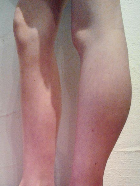 Swelling and volume increase of the left calf 
