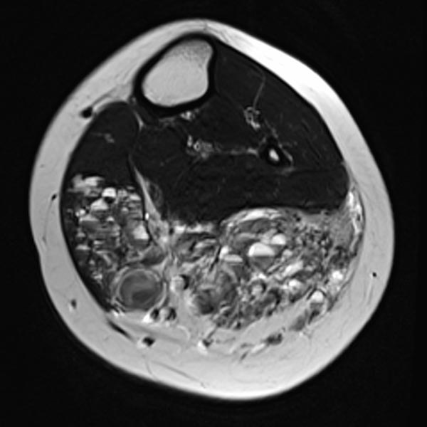 MRI: multiple dilated, dysplastic veins in a venous malformation