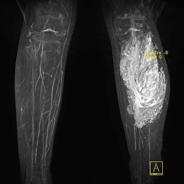 MR angiography: venous malformation